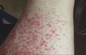 Mosquito Control Near Me